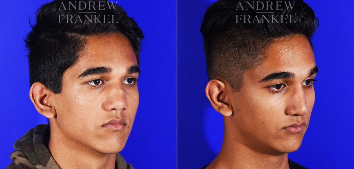 Revision Rhinoplasty before and after photos in Beverly Hills, CA, Patient 12553