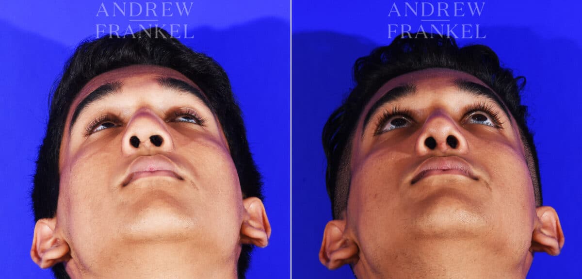 Revision Rhinoplasty before and after photos in Beverly Hills, CA, Patient 12553