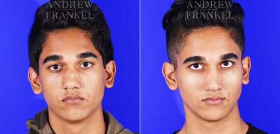 Revision Rhinoplasty before and after photos in Beverly Hills, CA, Patient 12553