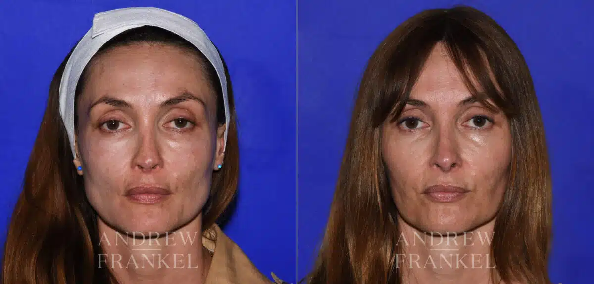 Revision Rhinoplasty before and after photos in Beverly Hills, CA, Patient 21856