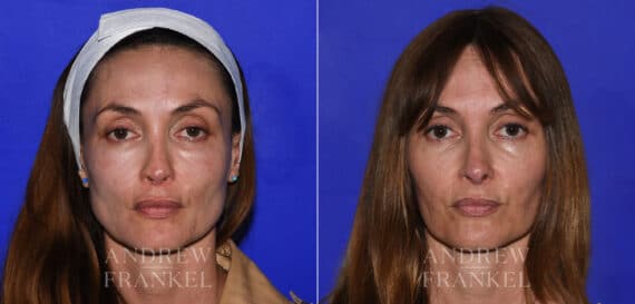 Revision Rhinoplasty before and after photos in Beverly Hills, CA, Patient 21856