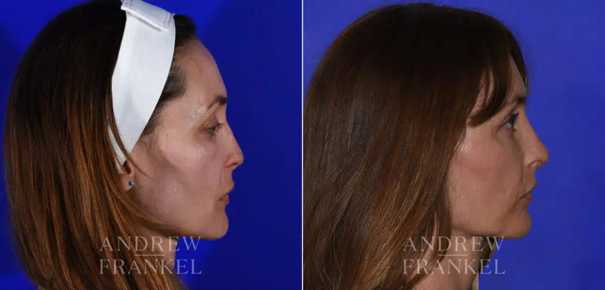 Revision Rhinoplasty before and after photos in Beverly Hills, CA, Patient 21856