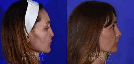 Revision Rhinoplasty before and after photos in Beverly Hills, CA, Patient 21856