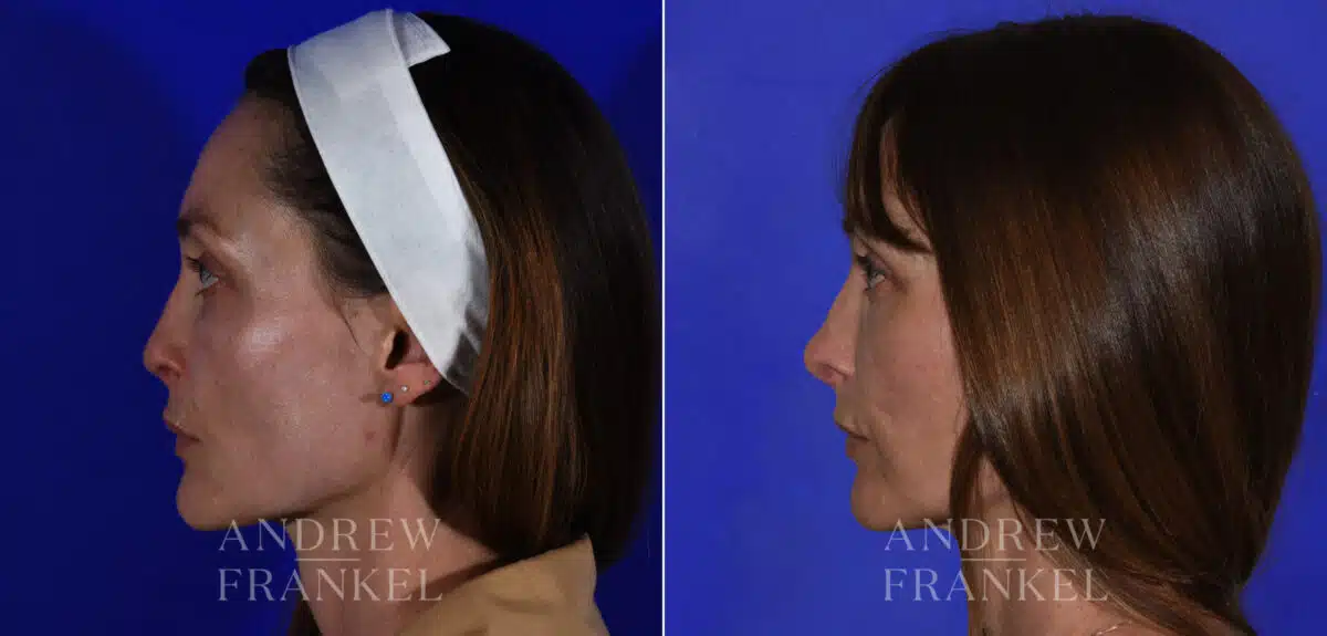 Revision Rhinoplasty before and after photos in Beverly Hills, CA, Patient 21856