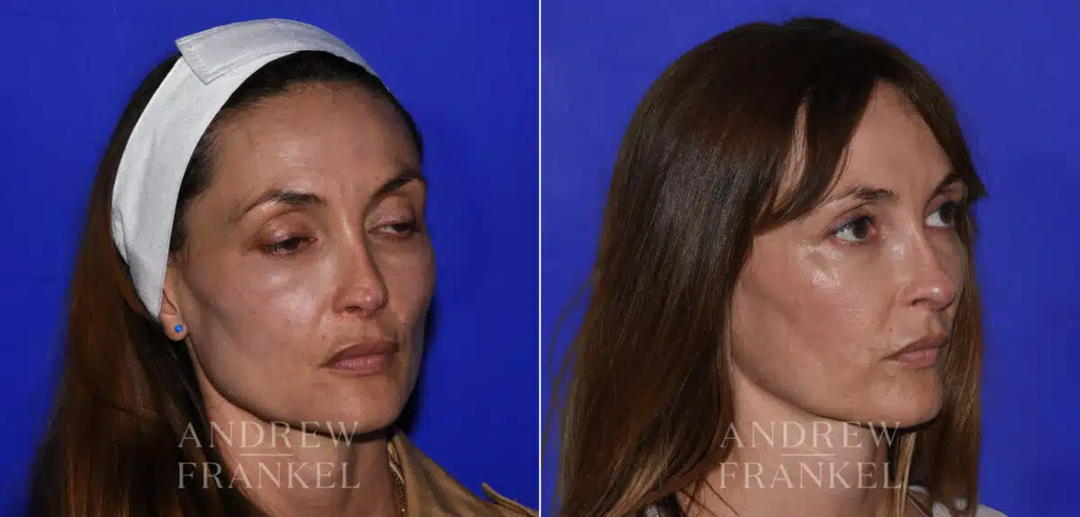 Revision Rhinoplasty before and after photos in Beverly Hills, CA, Patient 21856