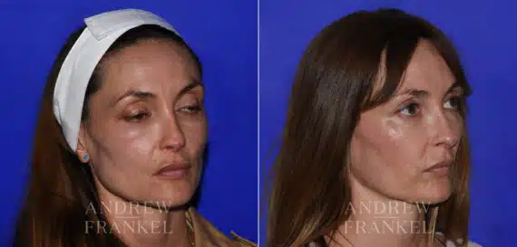 Revision Rhinoplasty before and after photos in Beverly Hills, CA, Patient 21856