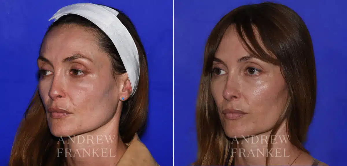 Revision Rhinoplasty before and after photos in Beverly Hills, CA, Patient 21856