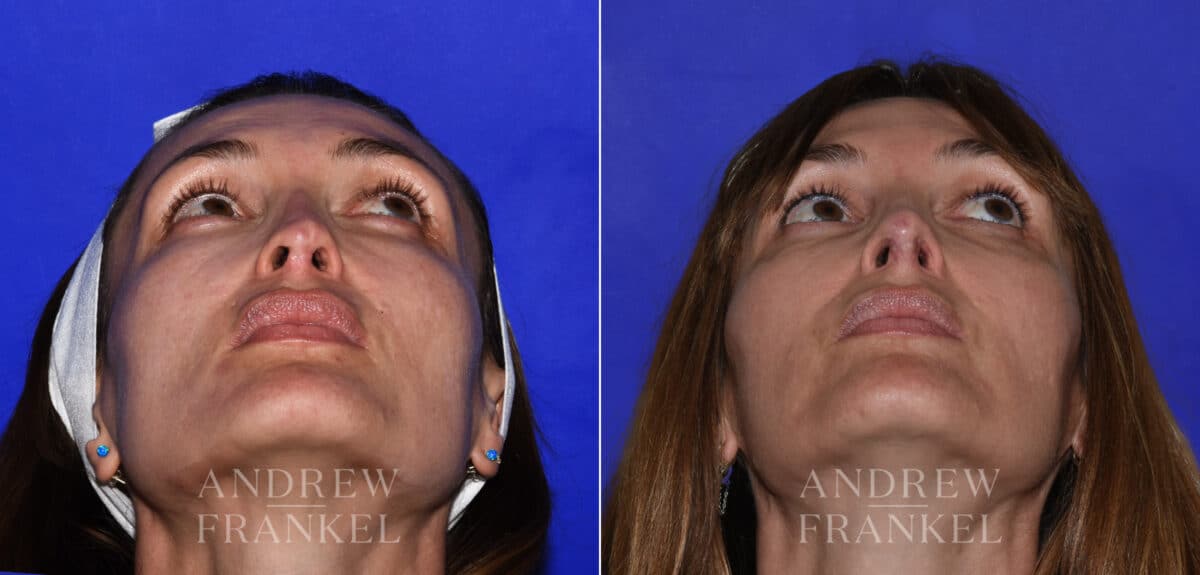 Revision Rhinoplasty before and after photos in Beverly Hills, CA, Patient 21856
