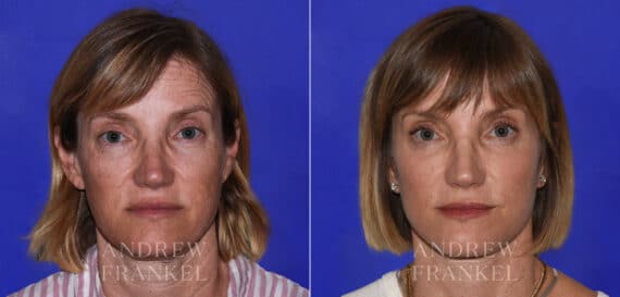 Facial Rejuvenation before and after photos in Beverly Hills, CA, Patient 21897