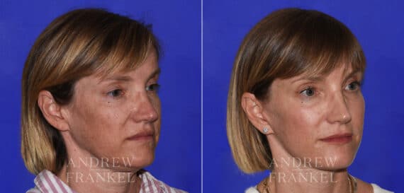 Facial Rejuvenation before and after photos in Beverly Hills, CA, Patient 21897