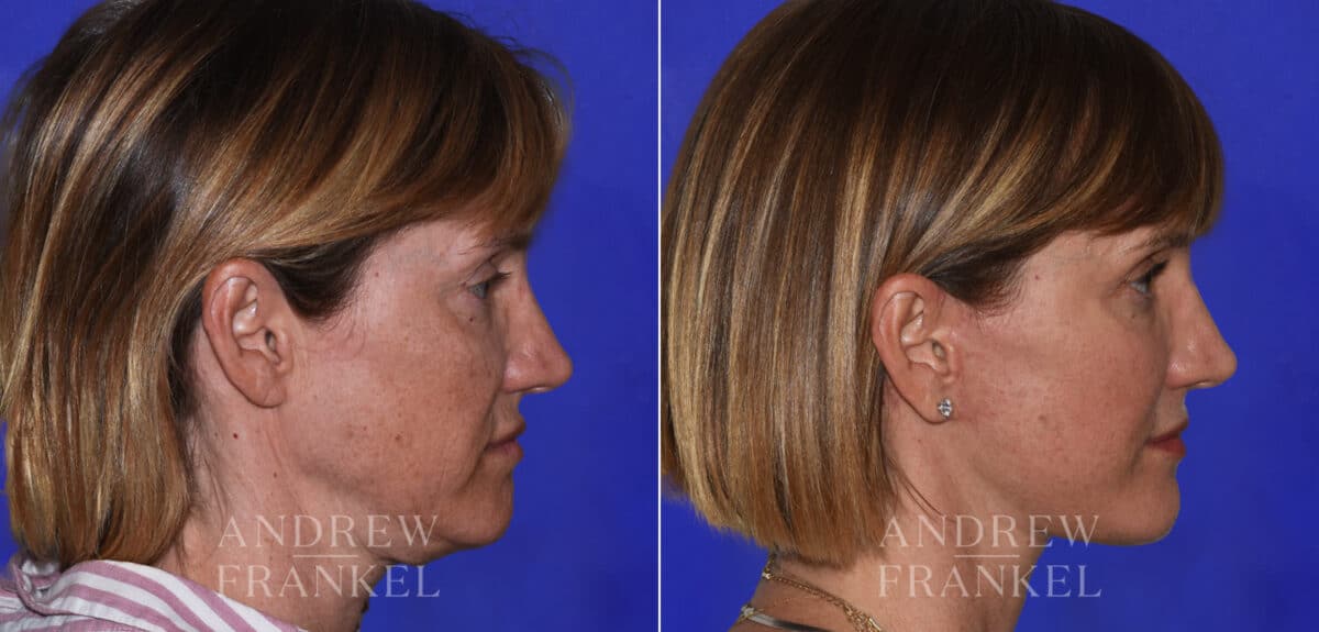 Facial Rejuvenation before and after photos in Beverly Hills, CA, Patient 21897