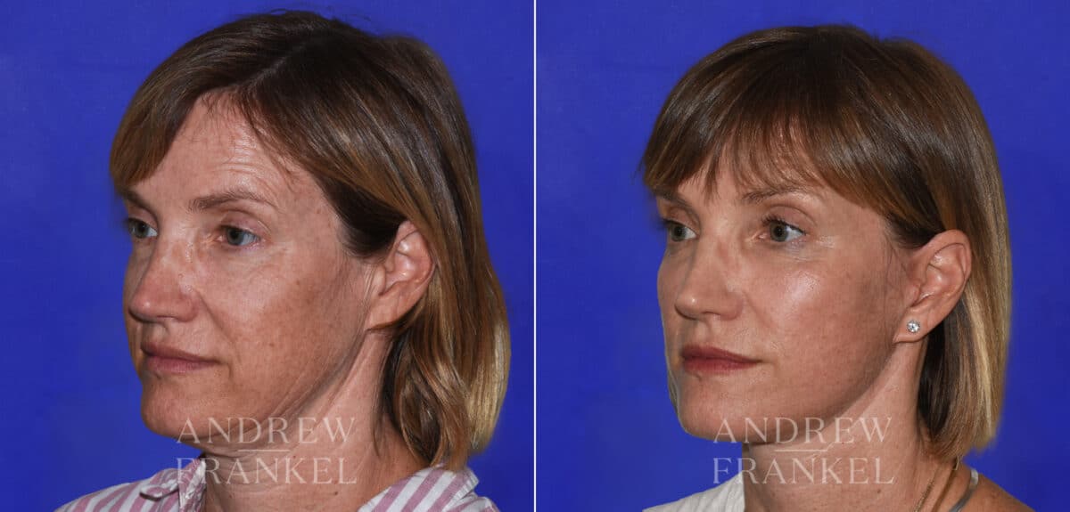 Facial Rejuvenation before and after photos in Beverly Hills, CA, Patient 21897