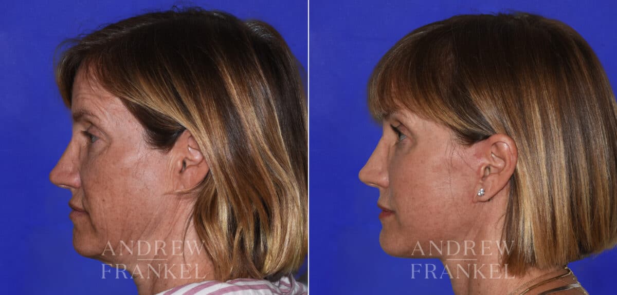 Facial Rejuvenation before and after photos in Beverly Hills, CA, Patient 21897