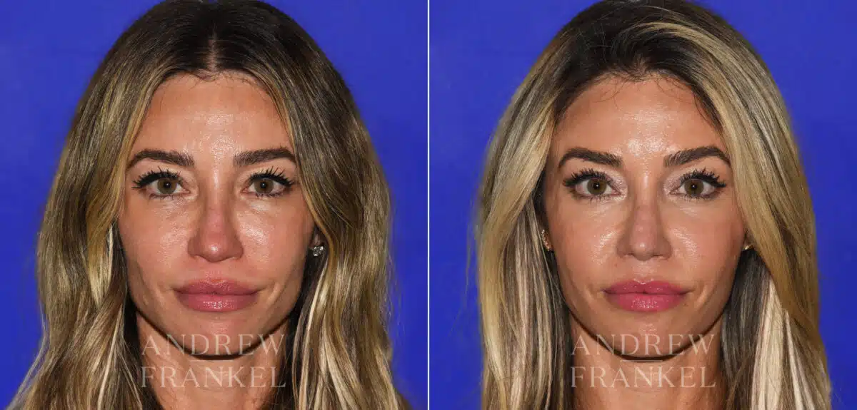 Revision Rhinoplasty before and after photos in Beverly Hills, CA, Patient 21915