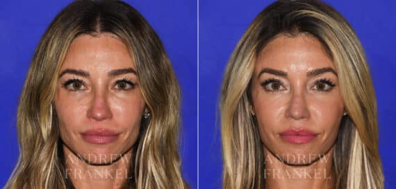 Revision Rhinoplasty before and after photos in Beverly Hills, CA, Patient 21915