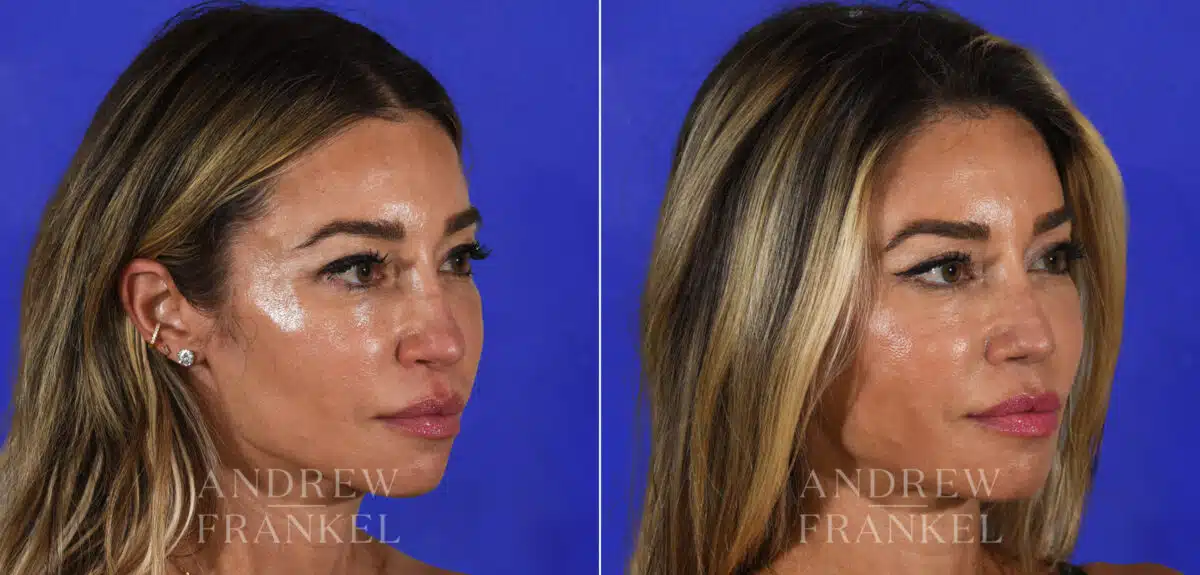 Revision Rhinoplasty before and after photos in Beverly Hills, CA, Patient 21915
