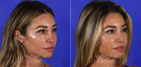 Revision Rhinoplasty before and after photos in Beverly Hills, CA, Patient 21915