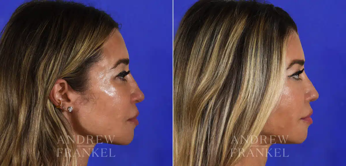 Revision Rhinoplasty before and after photos in Beverly Hills, CA, Patient 21915