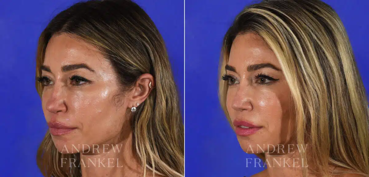 Revision Rhinoplasty before and after photos in Beverly Hills, CA, Patient 21915