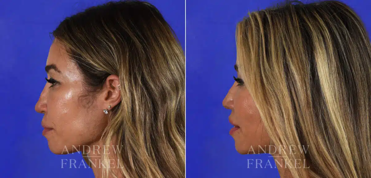 Revision Rhinoplasty before and after photos in Beverly Hills, CA, Patient 21915