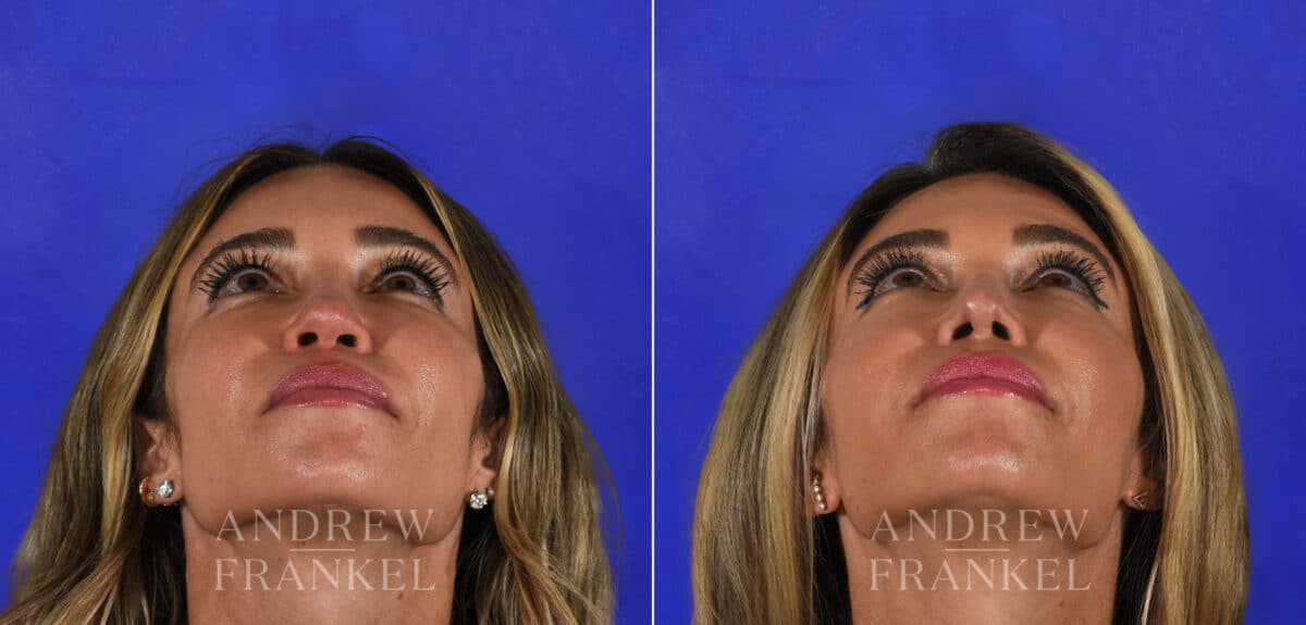 Revision Rhinoplasty before and after photos in Beverly Hills, CA, Patient 21915