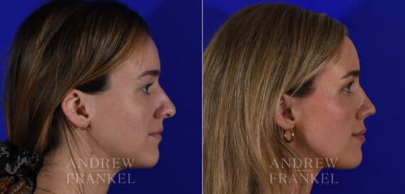 Rhinoplasty before and after photos in Beverly Hills, CA, Patient 21967