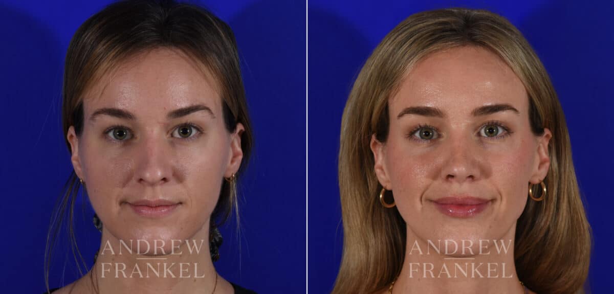 Rhinoplasty before and after photos in Beverly Hills, CA, Patient 21967