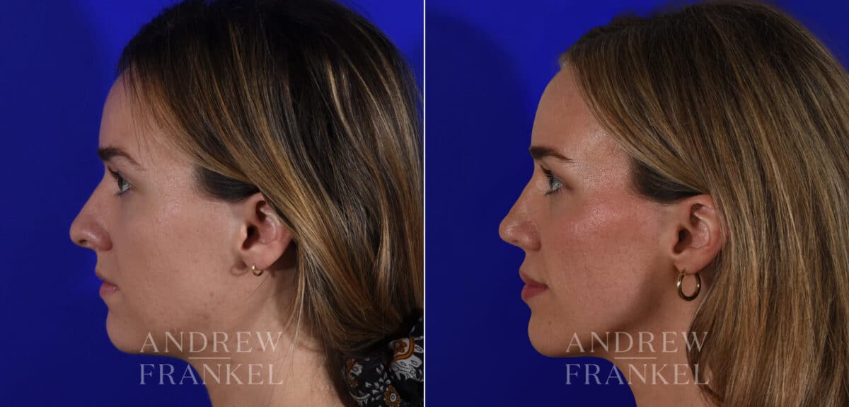 Rhinoplasty before and after photos in Beverly Hills, CA, Patient 21967