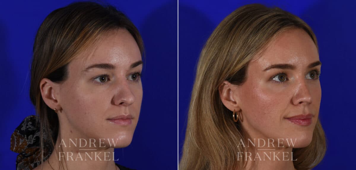 Rhinoplasty before and after photos in Beverly Hills, CA, Patient 21967