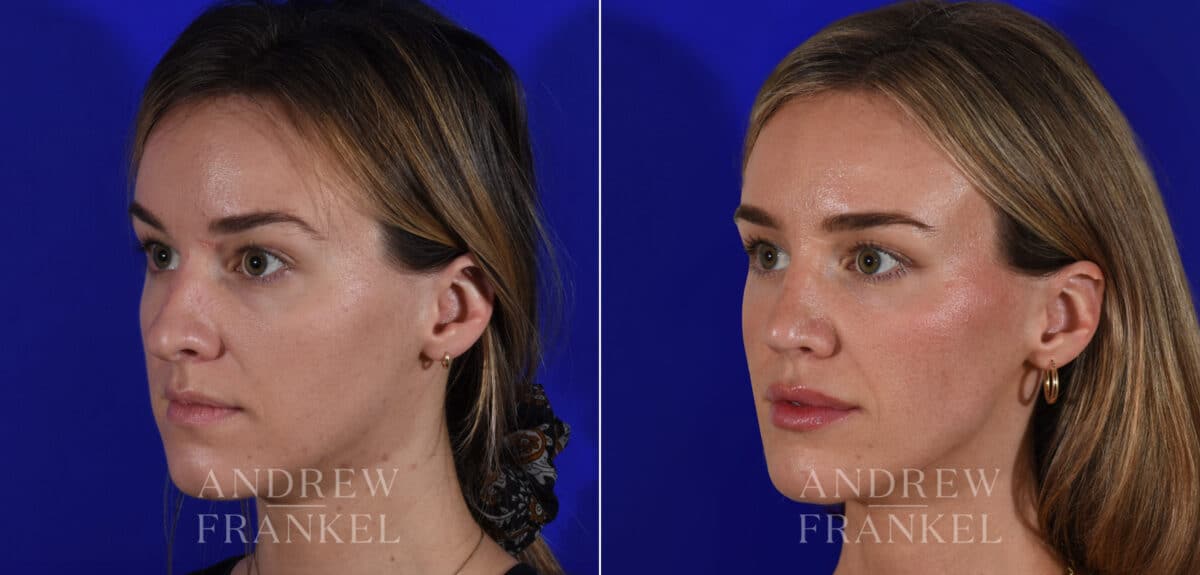 Rhinoplasty before and after photos in Beverly Hills, CA, Patient 21967
