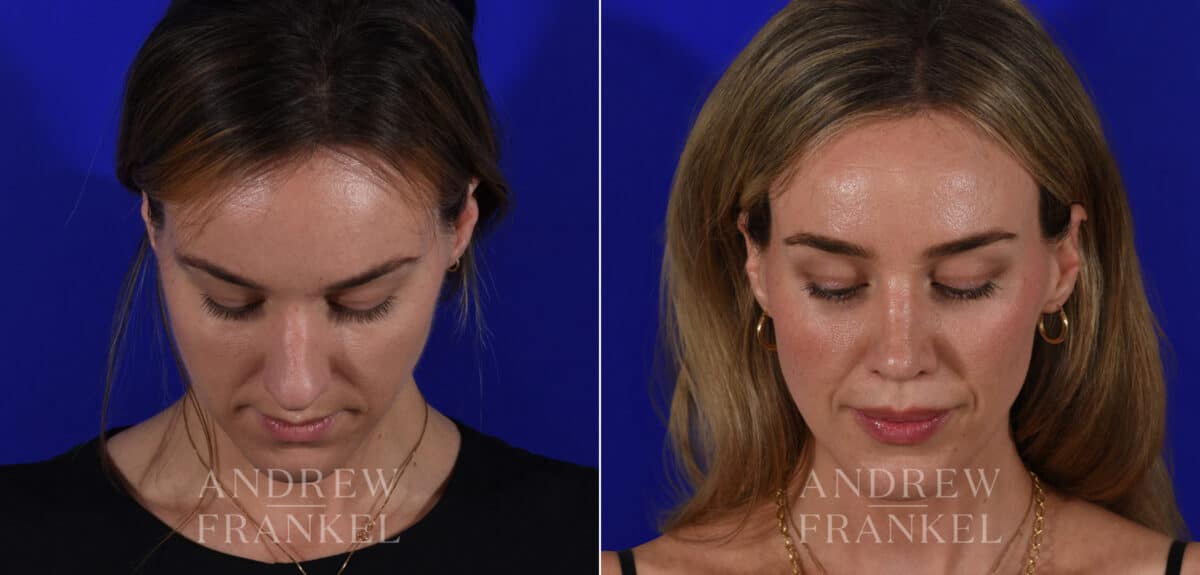 Rhinoplasty before and after photos in Beverly Hills, CA, Patient 21967