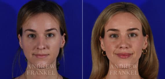 Rhinoplasty before and after photos in Beverly Hills, CA, Patient 21967