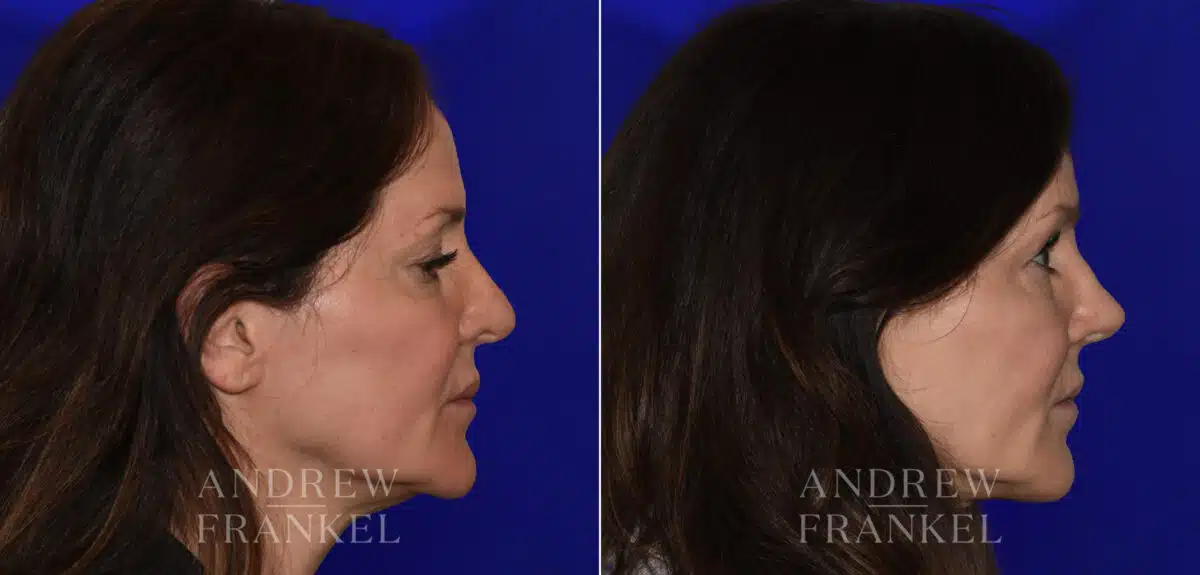 Revision Rhinoplasty before and after photos in Beverly Hills, CA, Patient 21986