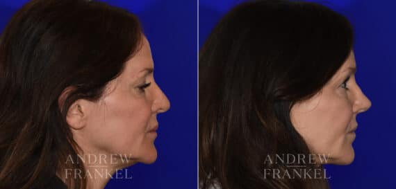 Revision Rhinoplasty before and after photos in Beverly Hills, CA, Patient 21986