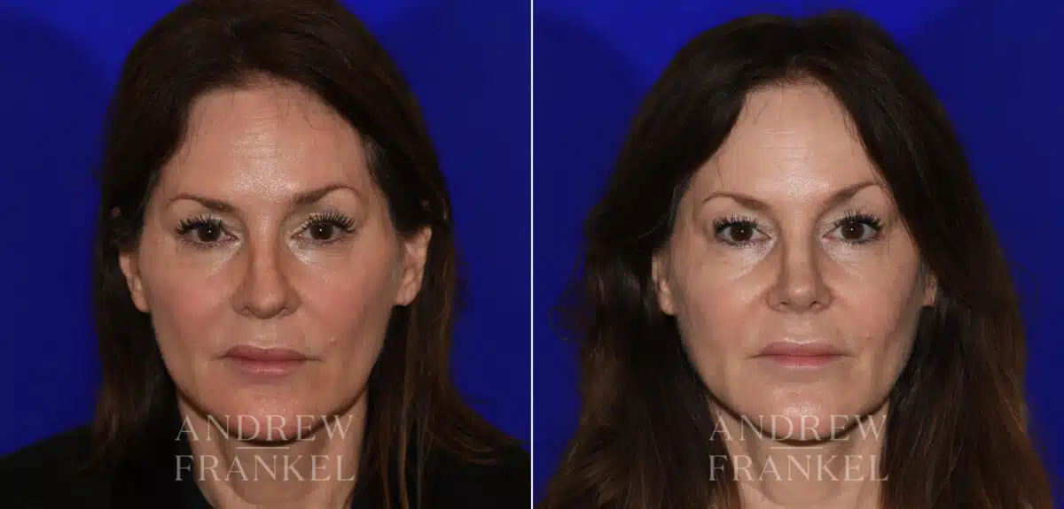 Revision Rhinoplasty before and after photos in Beverly Hills, CA, Patient 21986