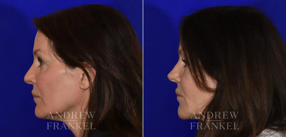 Revision Rhinoplasty before and after photos in Beverly Hills, CA, Patient 21986