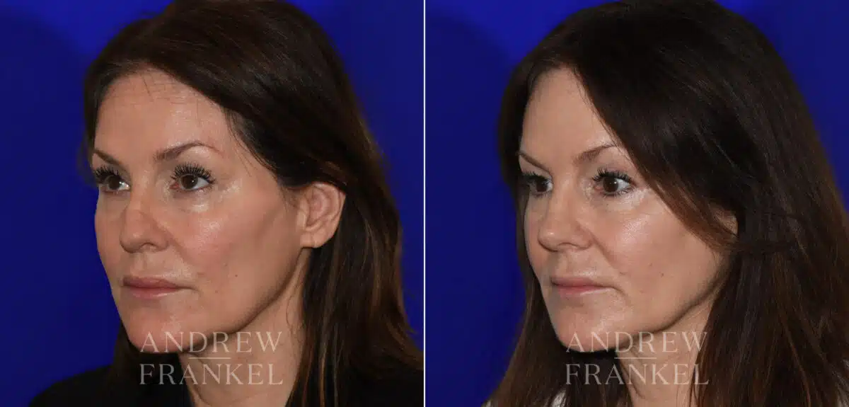 Revision Rhinoplasty before and after photos in Beverly Hills, CA, Patient 21986