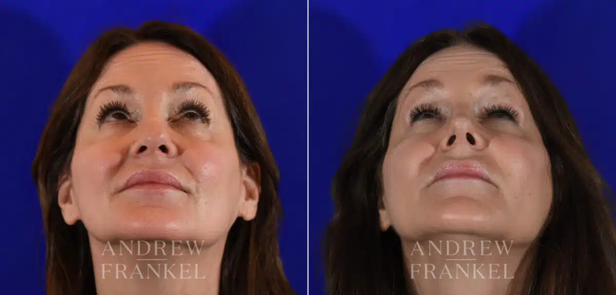 Revision Rhinoplasty before and after photos in Beverly Hills, CA, Patient 21986