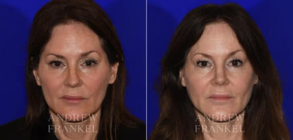 Revision Rhinoplasty before and after photos in Beverly Hills, CA, Patient 21986
