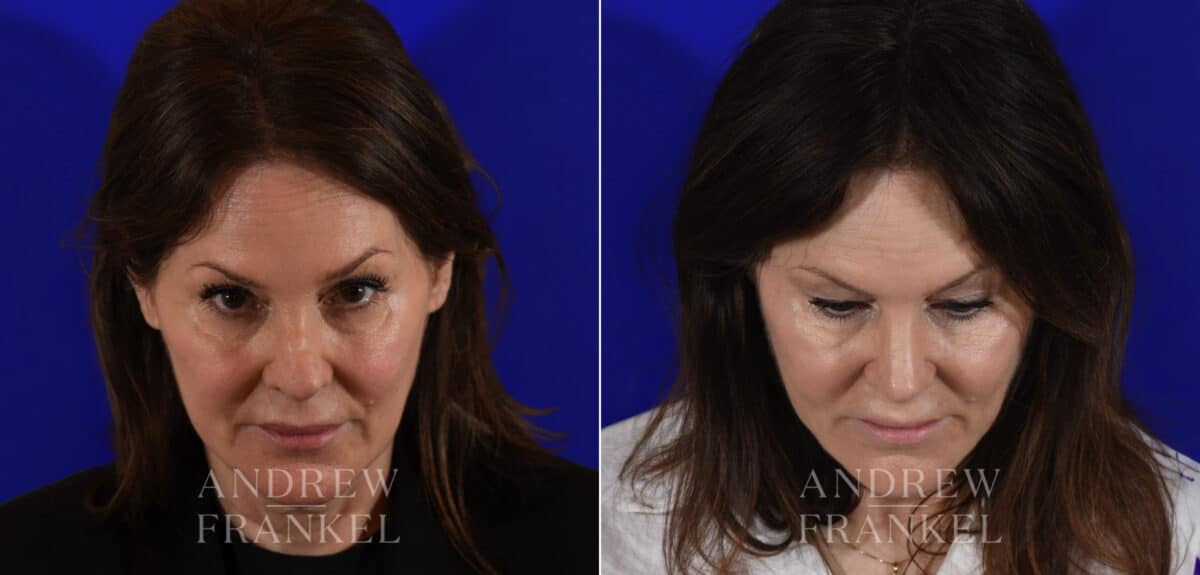 Revision Rhinoplasty before and after photos in Beverly Hills, CA, Patient 21986