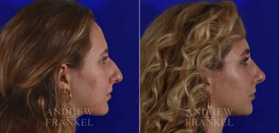 Rhinoplasty before and after photos in Beverly Hills, CA, Patient 17920