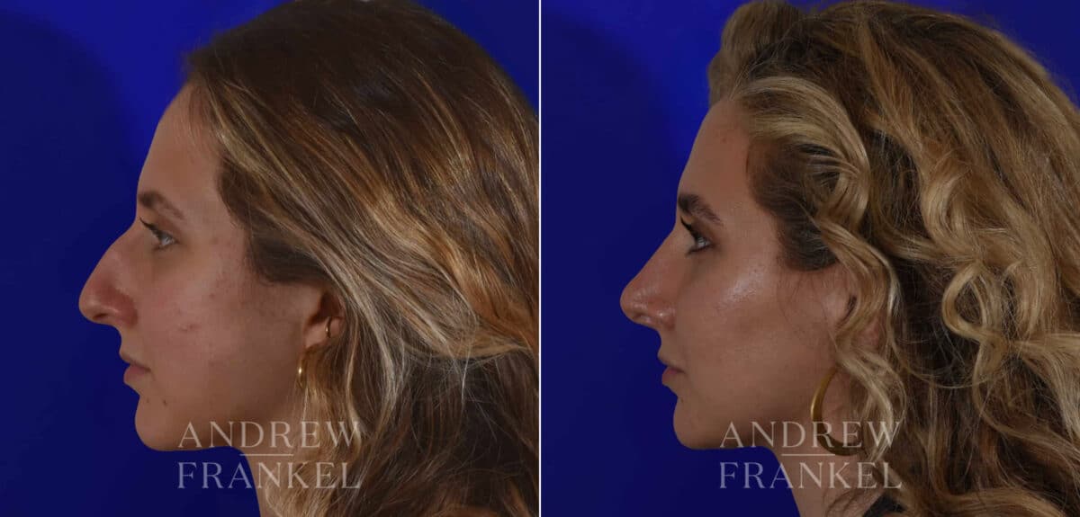 Rhinoplasty before and after photos in Beverly Hills, CA, Patient 17920