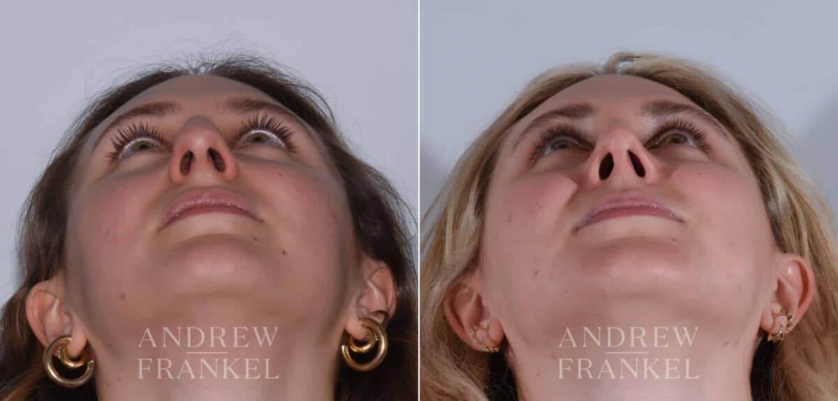 Rhinoplasty before and after photos in Beverly Hills, CA, Patient 17920