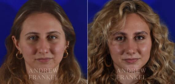 Rhinoplasty before and after photos in Beverly Hills, CA, Patient 17920