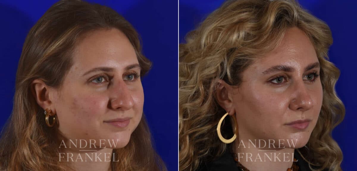Rhinoplasty before and after photos in Beverly Hills, CA, Patient 17920