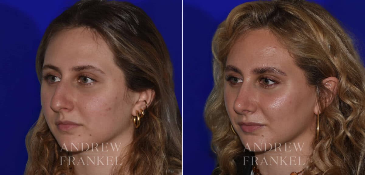 Rhinoplasty before and after photos in Beverly Hills, CA, Patient 17920