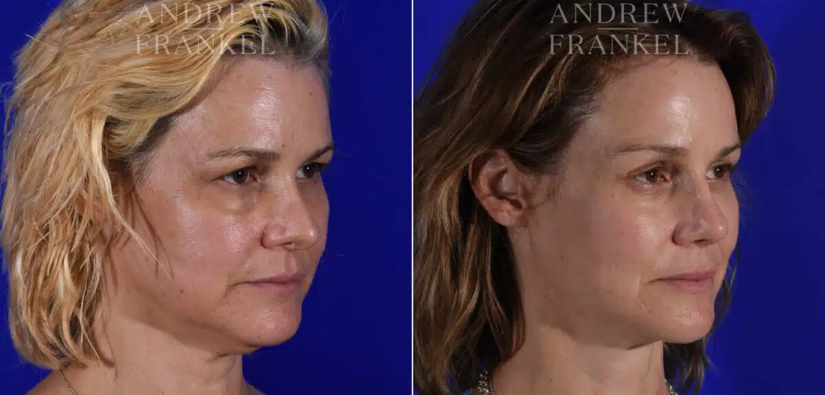 Brow Lift before and after photos in Beverly Hills, CA, Patient 21883