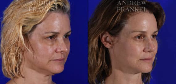 Brow Lift before and after photos in Beverly Hills, CA, Patient 21883