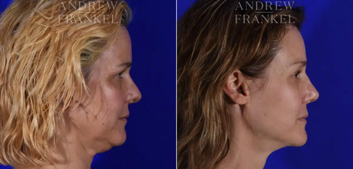 Brow Lift before and after photos in Beverly Hills, CA, Patient 21883