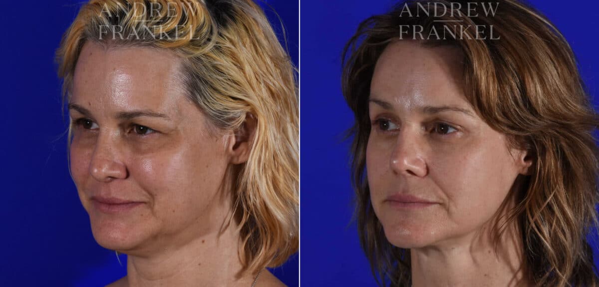 Brow Lift before and after photos in Beverly Hills, CA, Patient 21883